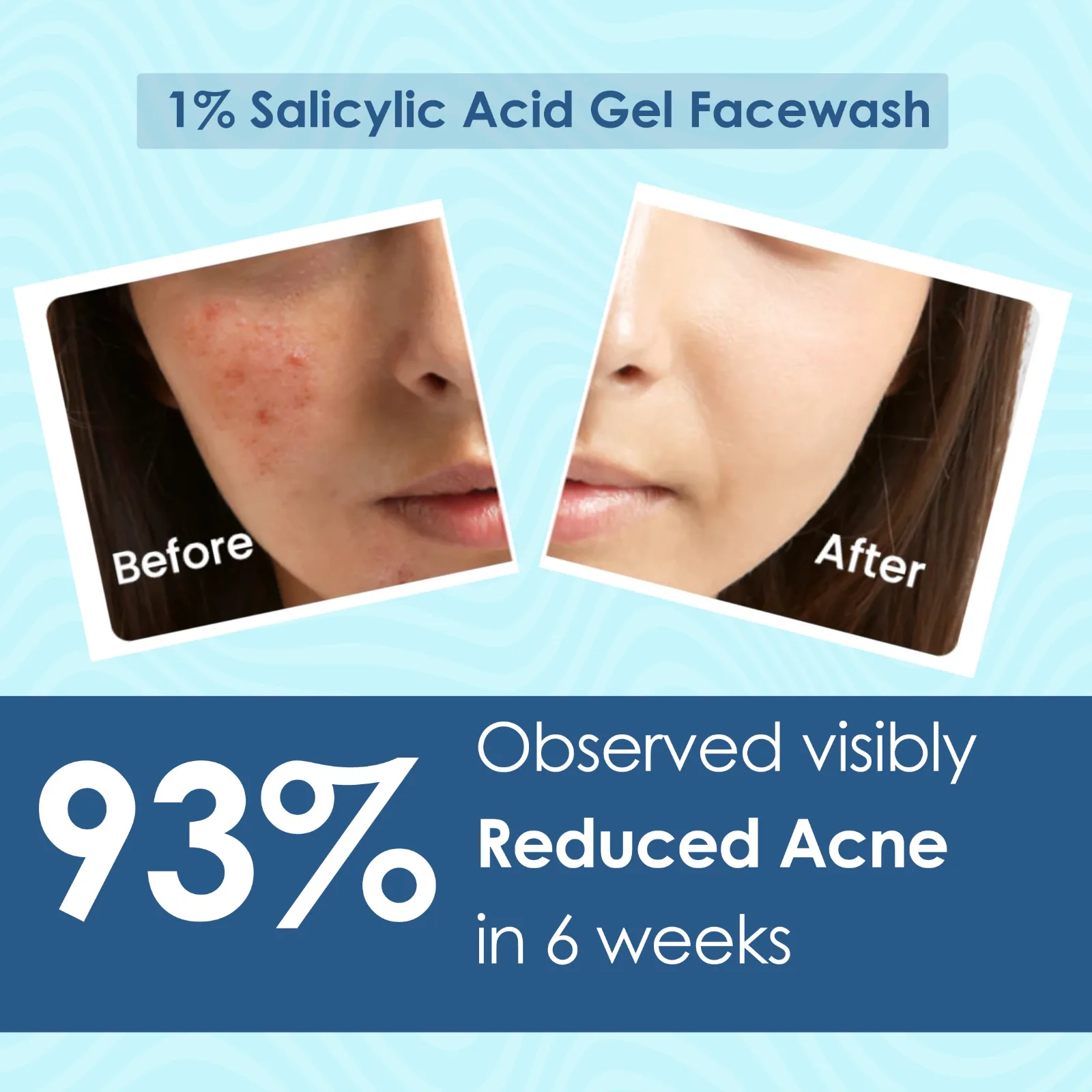 Pink Root 1% Salicylic Acid Gel Face Wash with kojic Acid for acne skin & bumpy Skin - 100 ml view 4